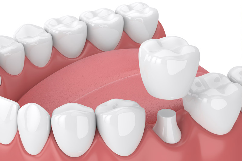 Dental Crowns in York