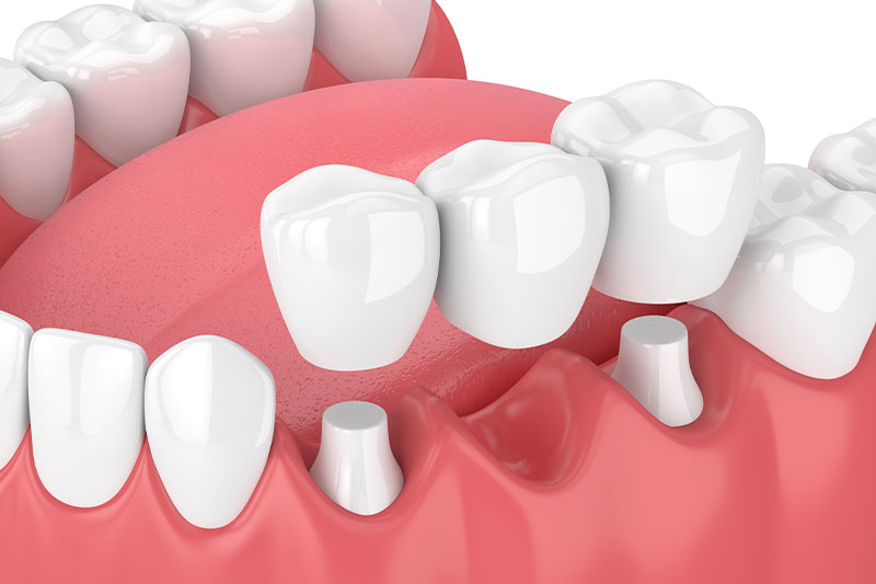 Dental Bridges in York