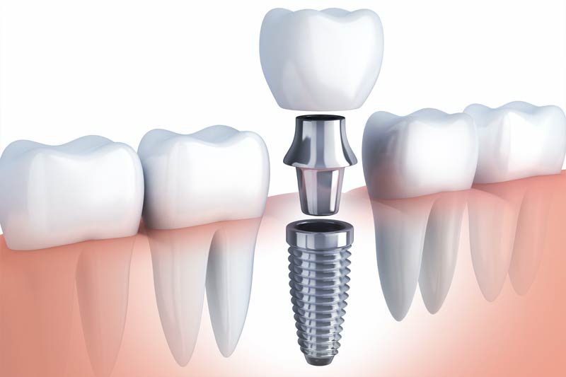 Implant Dentistry in York