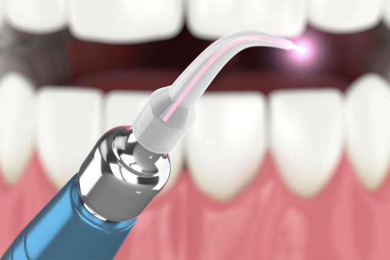 Laser Dentistry in York