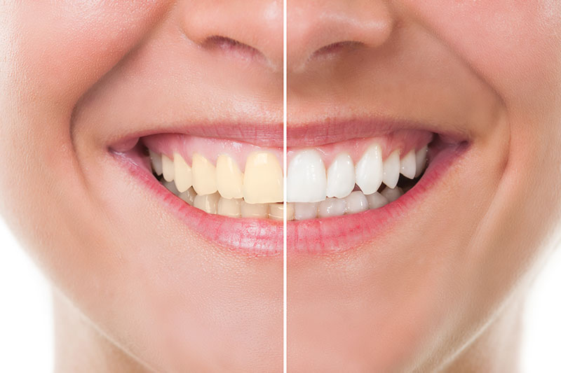 Teeth Whitening in York