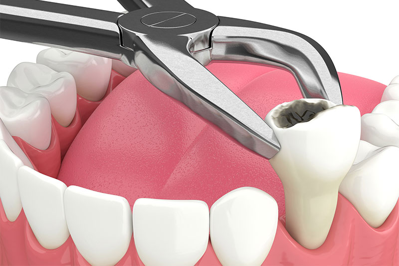 Tooth Extractions in York