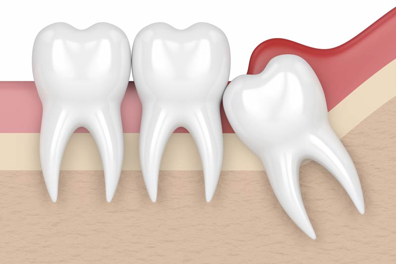 Wisdom Tooth Removal in York